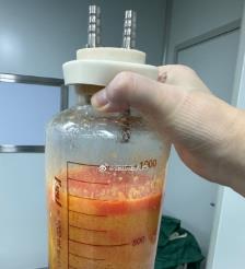 泗洪水动力吸脂手术要做多久？